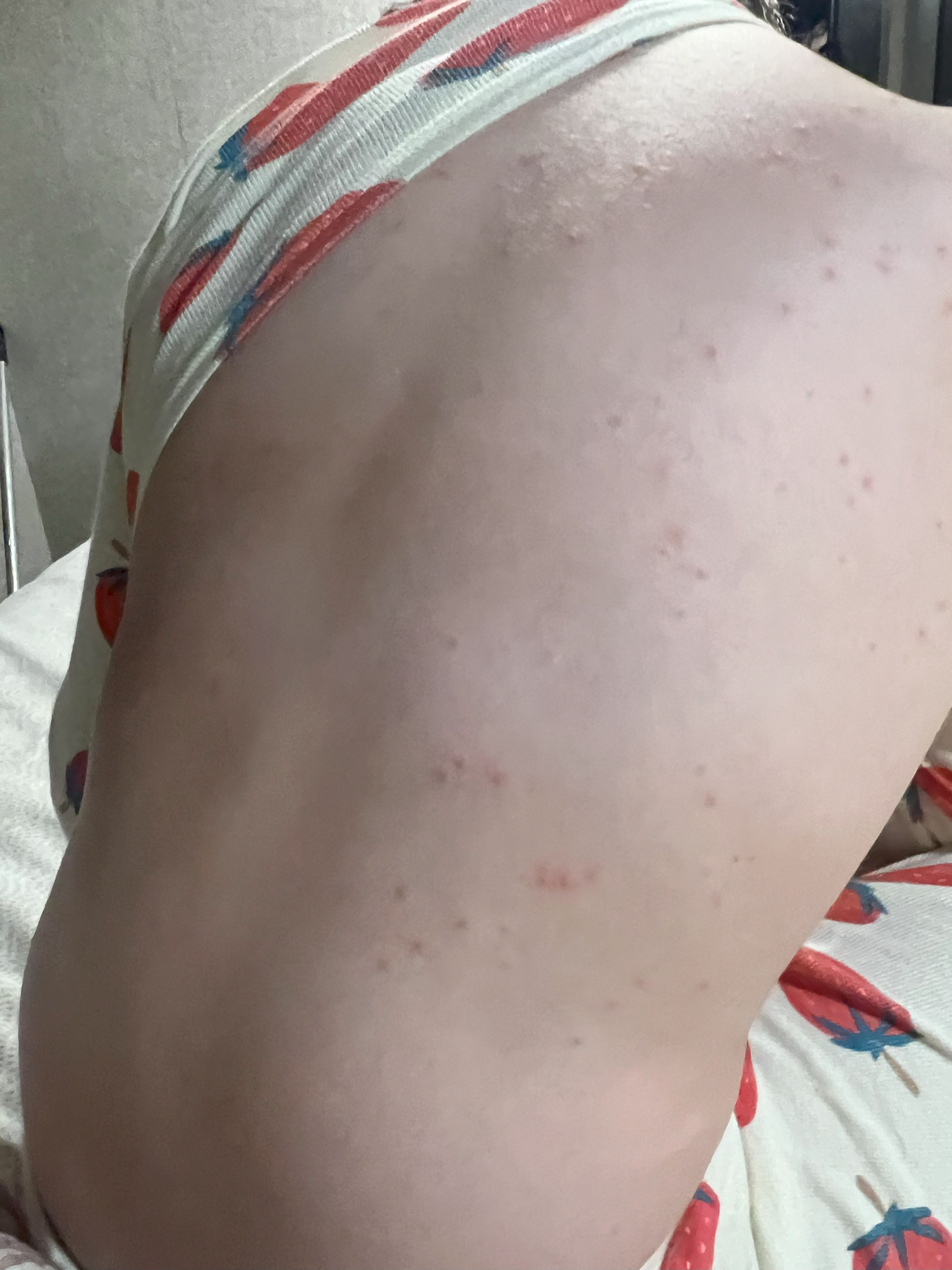 Hot tub rash